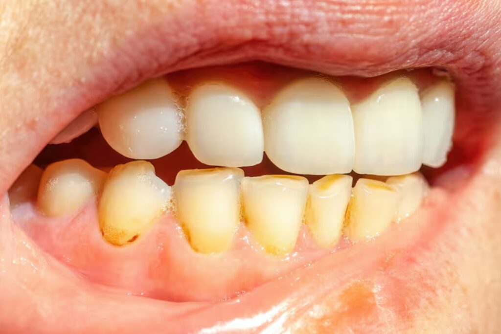 Miti sui trucchi casalinghi: cosa rimuove davvero il tartaro e come mantenere il sorriso